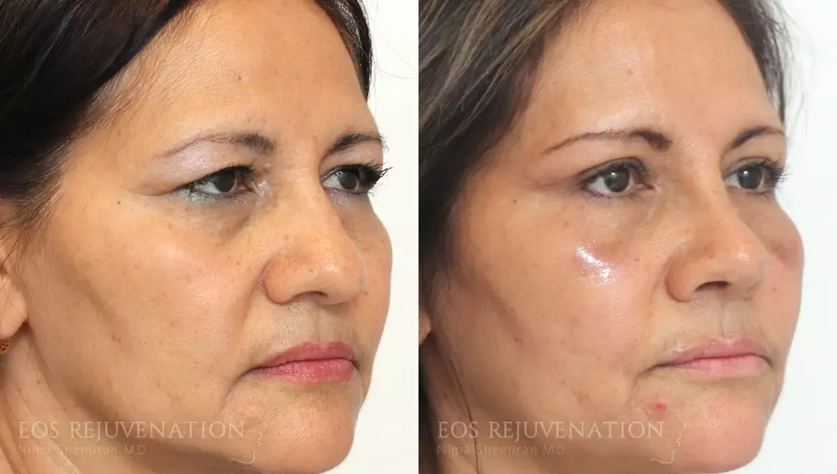 Brow Lift Before & After