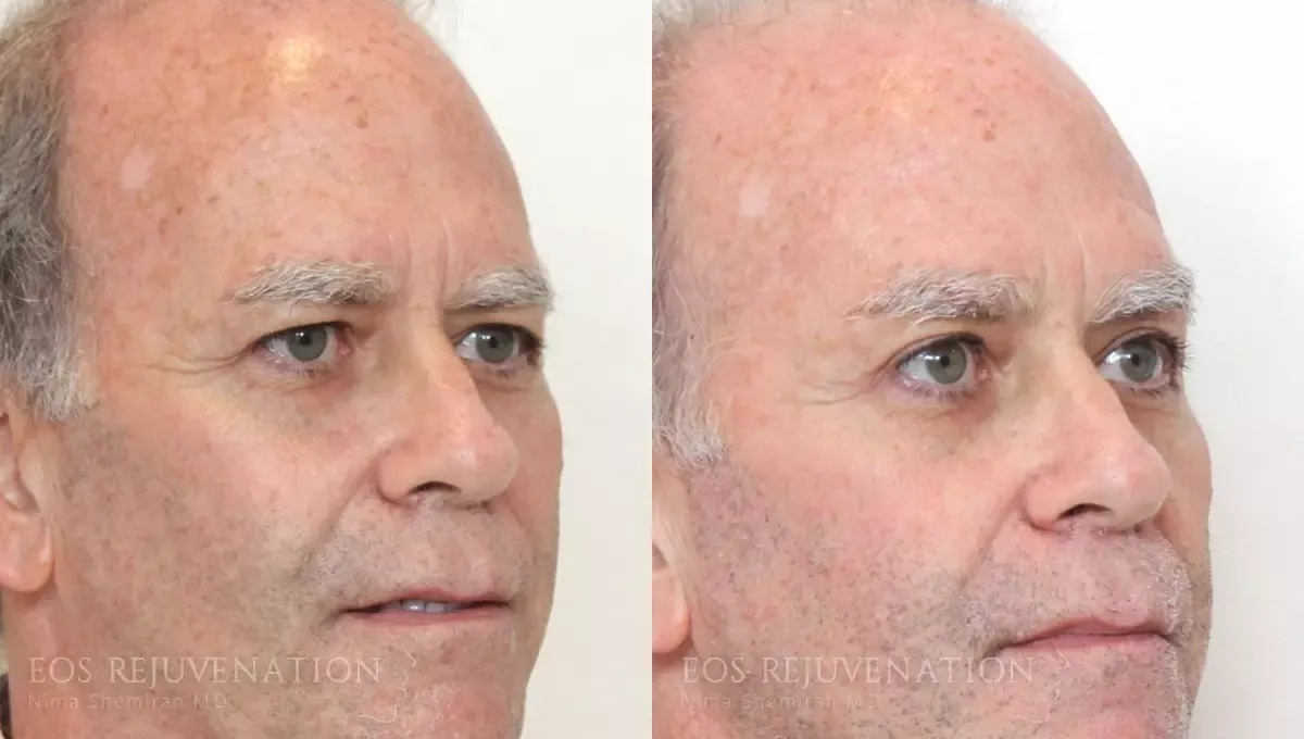 Brow Lift Before & After