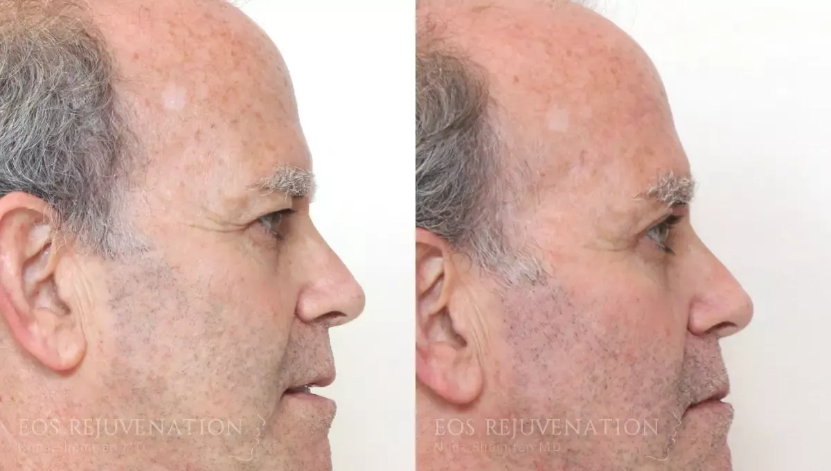 Brow Lift Before & After