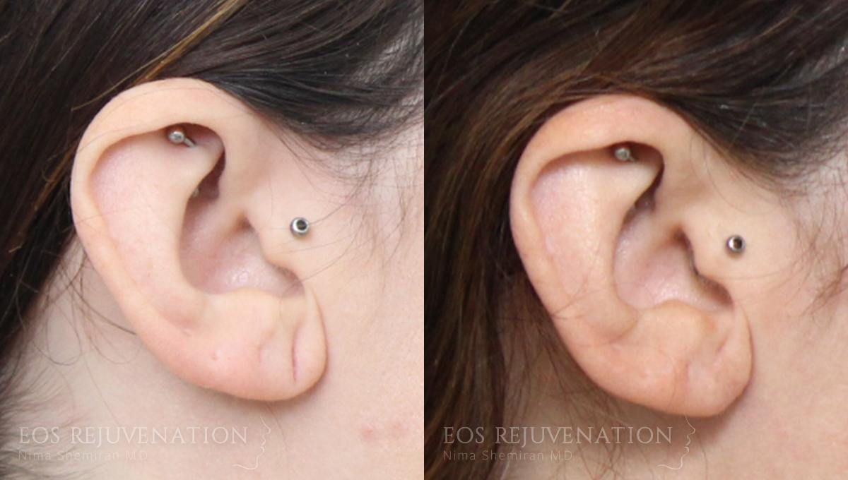 Earlobe Repair Before & After