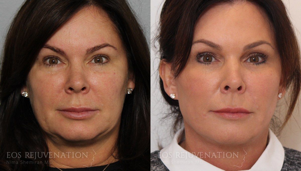 Buccal Fat Removal Before & After