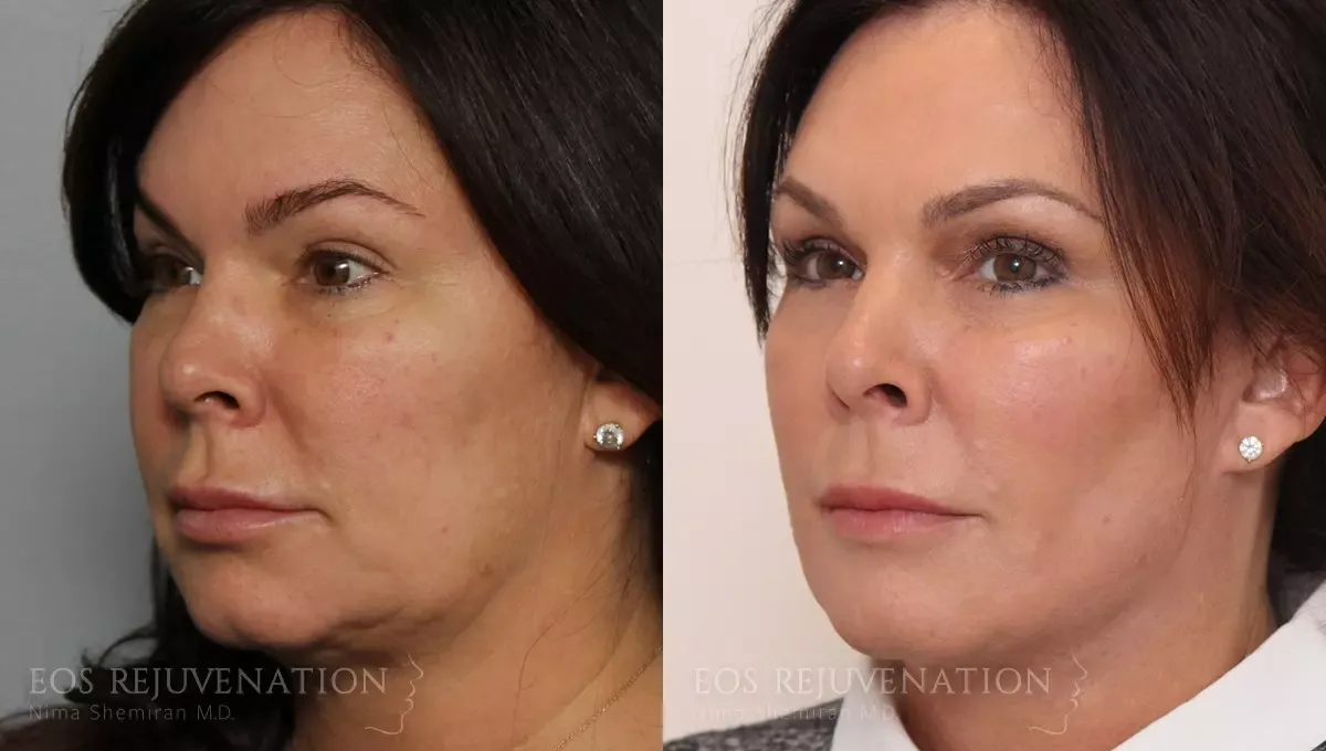 Buccal Fat Removal Before & After