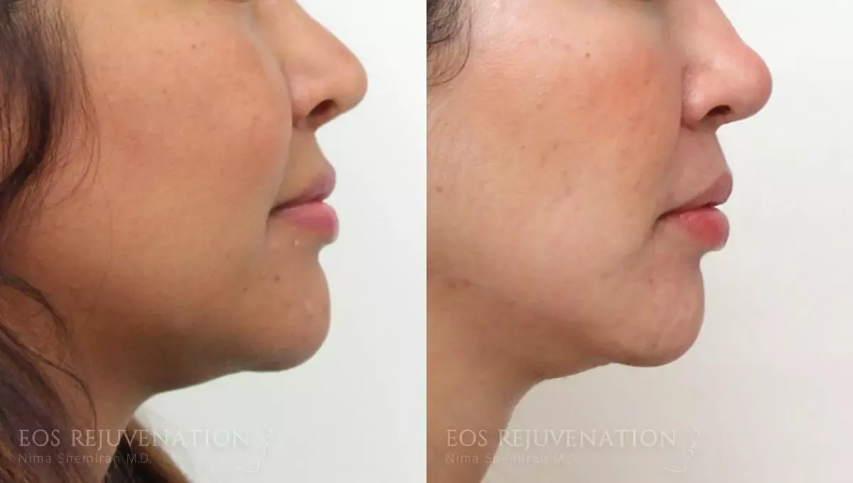 Buccal Fat Removal Before & After