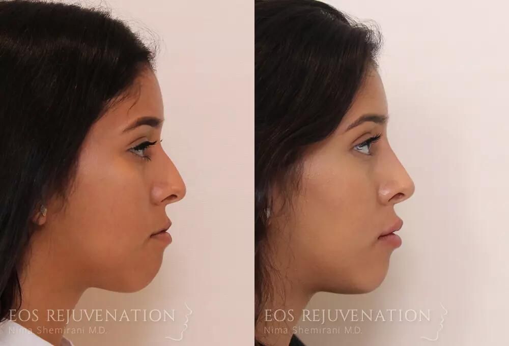 Non Surgical Rhinoplasty Before & After