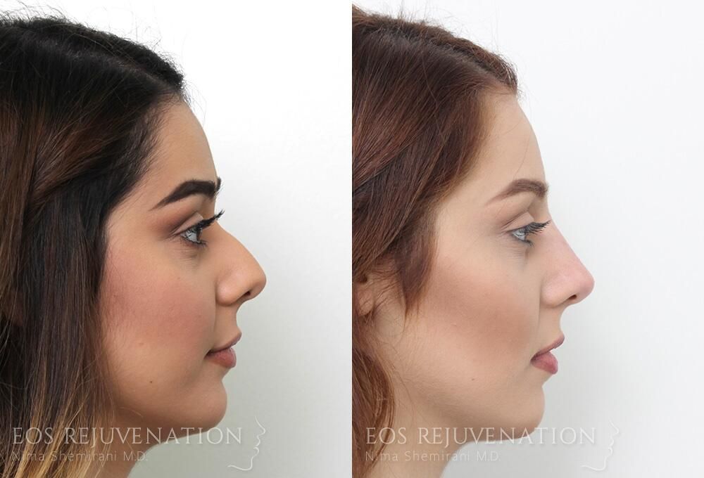 Non Surgical Rhinoplasty Before & After
