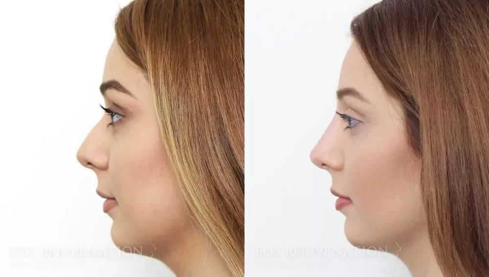 Non Surgical Rhinoplasty Before & After