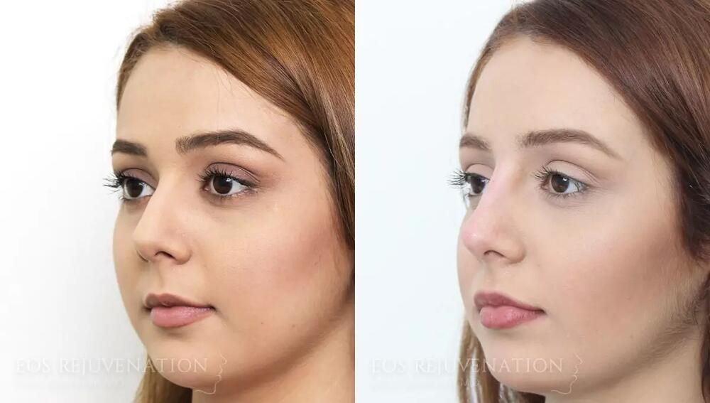 Non Surgical Rhinoplasty Before & After