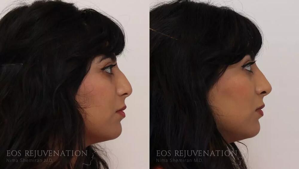 Non Surgical Rhinoplasty Before & After