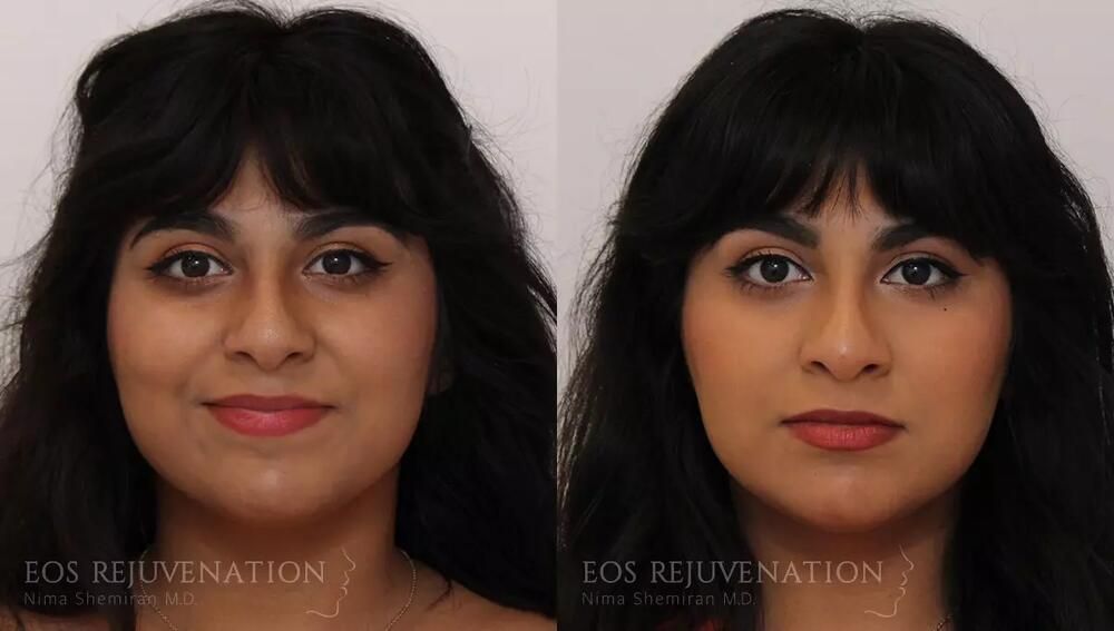 Non Surgical Rhinoplasty Before & After