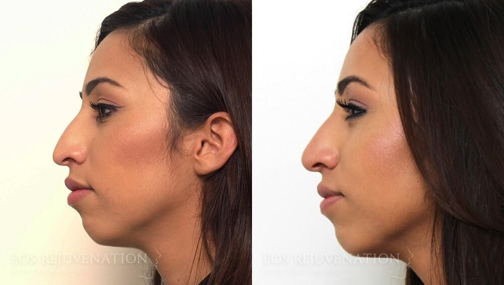 Non Surgical Rhinoplasty Before & After