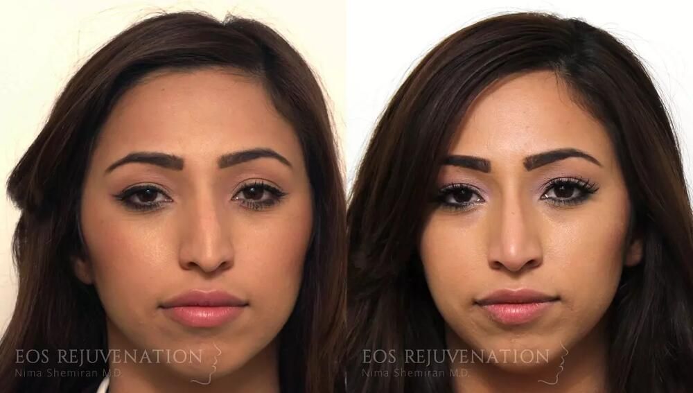 Non Surgical Rhinoplasty Before & After