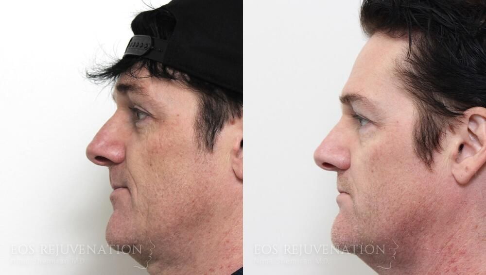 Non Surgical Rhinoplasty Before & After