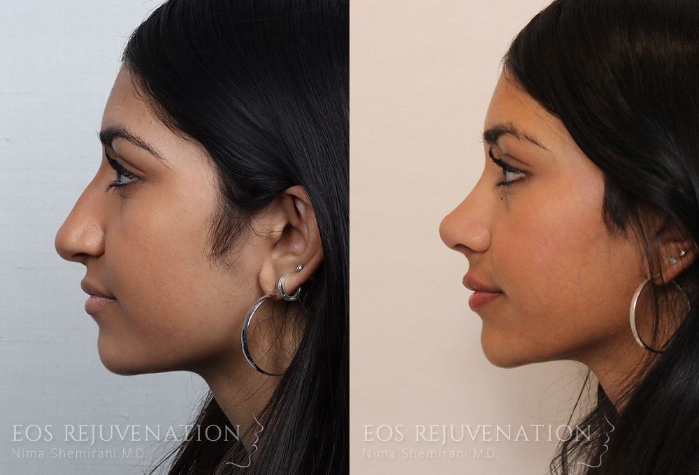 Barbie Nose Rhinoplasty Before & After