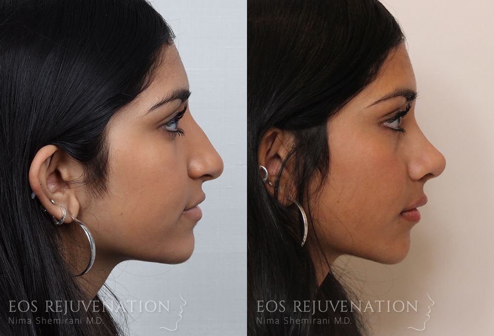 Barbie Nose Rhinoplasty Before & After