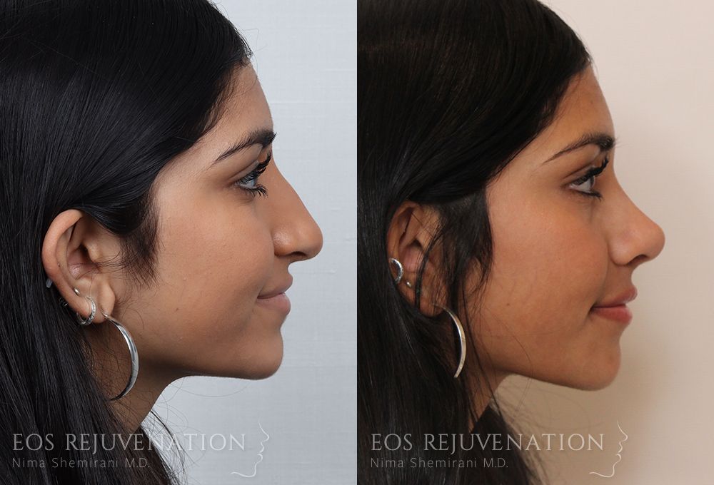 Barbie Nose Rhinoplasty Before & After